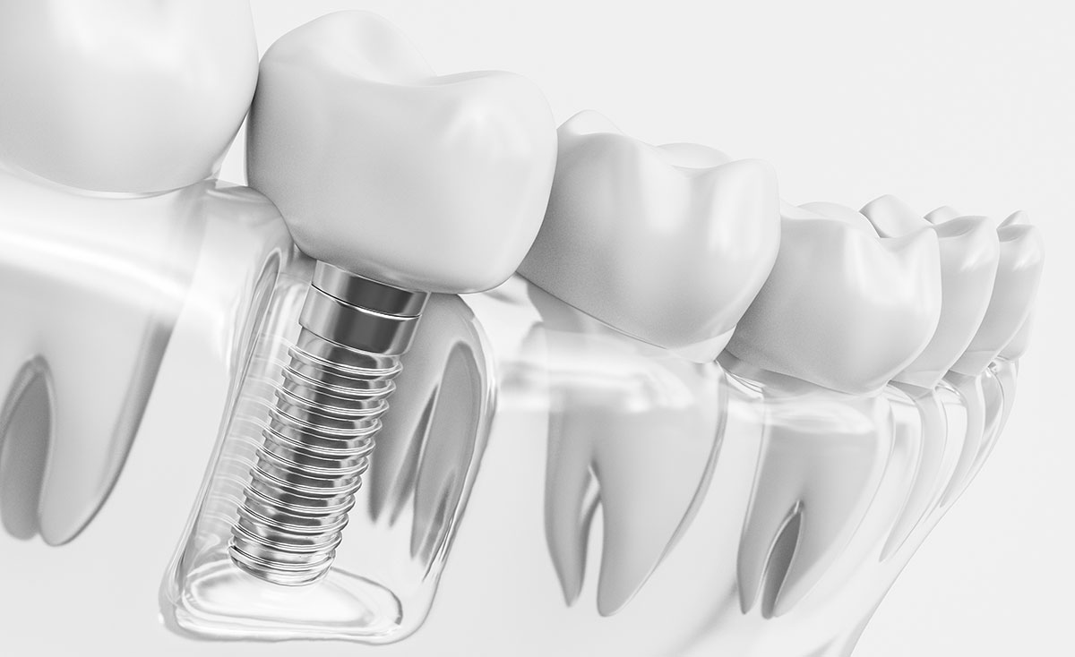 Implantes